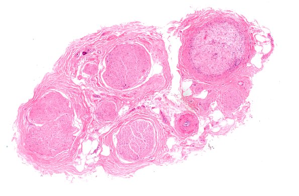 3A1 Perineurium hyperplasia case (Case 3) H&E 4X 2