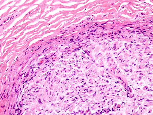 3A3 Perineurium hyperplasia case (Case 3) H&E 2