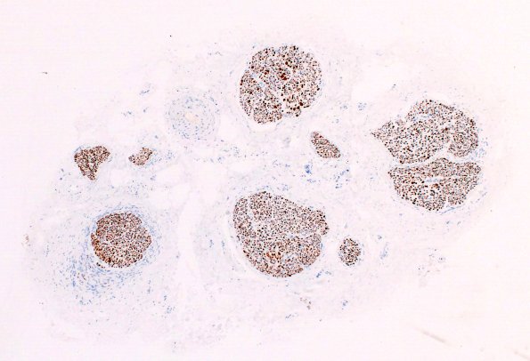 3B1 Perineurium hyperplasia case (Case 3) NF 4X