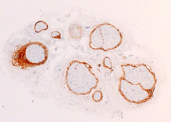 3C1 Perineurium hyperplasia case (Case 3) EMA 4X 1