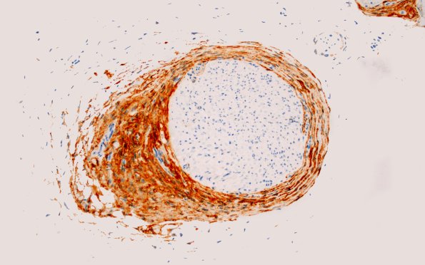 3C2 Perineurium hyperplasia case (Case 3) EMA 20X 2