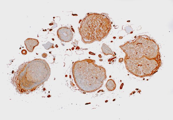 3D1 Perineurium hyperplasia case (Case 3) Coll IV 4X