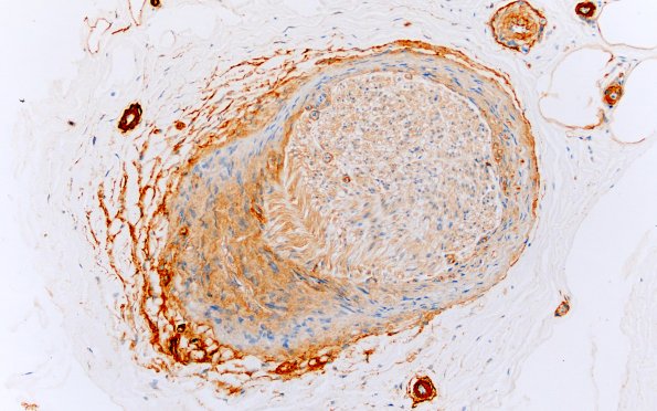 3D2 Perineurium hyperplasia case (Case 3) Coll IV 20X