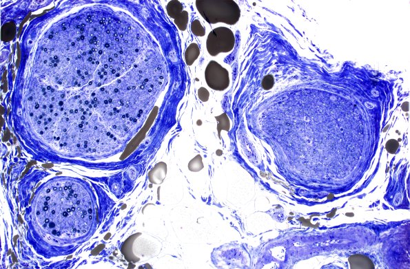 3E1 Perineurium hyperplasia case (Case 3) Plastic 10