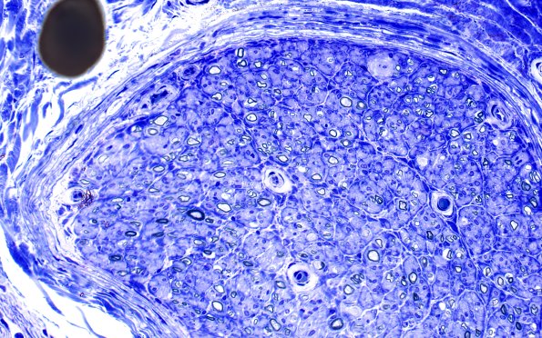 3E2 Perineurium hyperplasia case (Case 3) Plastic 40X 2