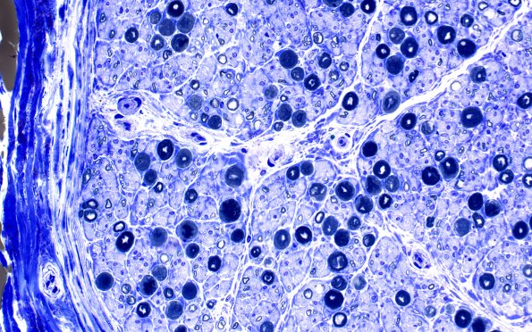 3E3 Perineurium hyperplasia case (Case 3) Plastic 40X 3