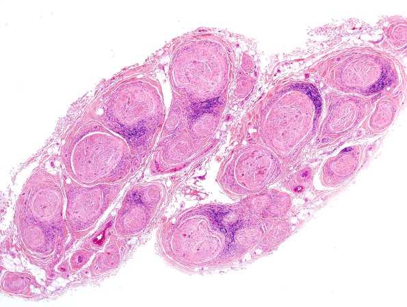 4A1 Perineuritis (Case 4) H&E 3