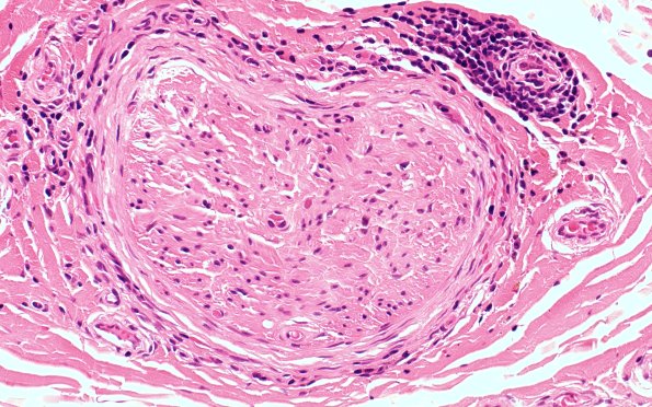 4A4 Perineuritis (Case 4) H&E 40X 1