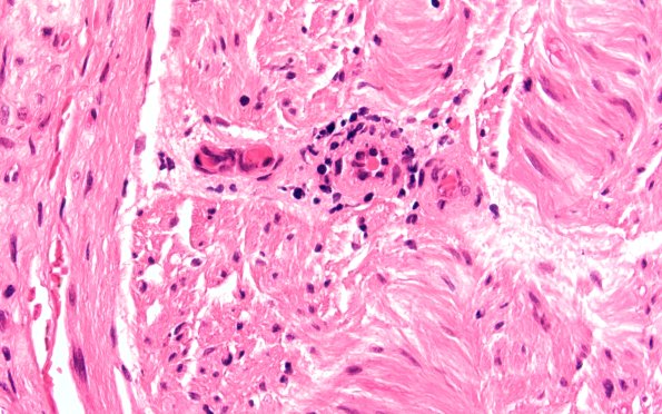 4A6 Perineuritis (Case 4) H&E 60X 1