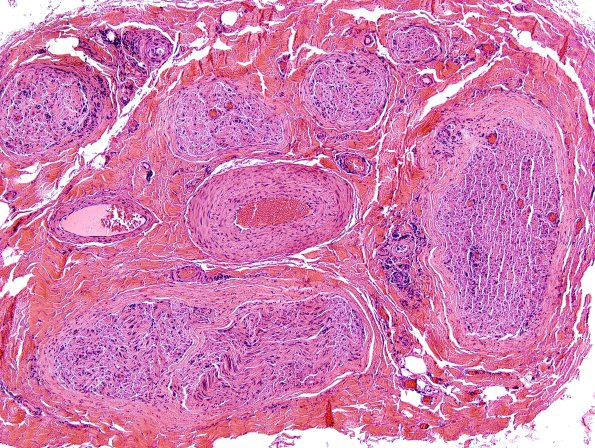 5A1 Perineuritis (Case 5) H&E 2 A