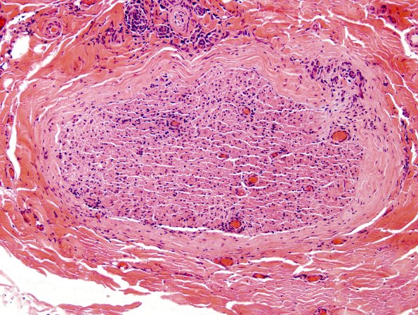 5A2 Perineuritis (Case 5) H&E 1