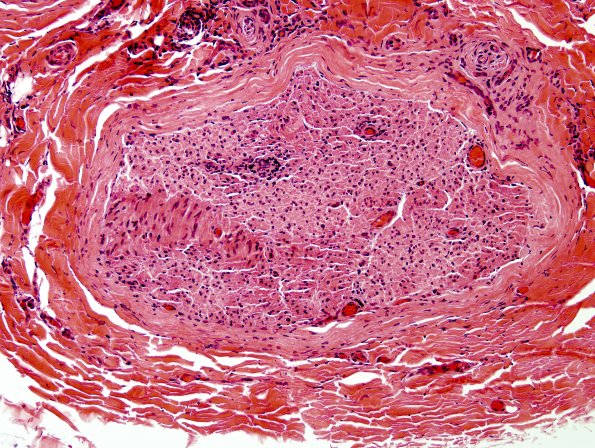 5A3 Perineuritis (Case 5) H&E 3