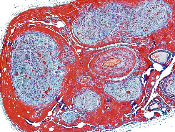 5B Perineuritis (Case 5) Trichrome