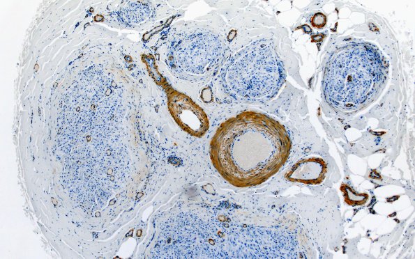 5C1 Perineuritis (Case 5) SMA 10X 2