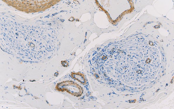 5C2 Perineuritis (Case 5) SMA 20X