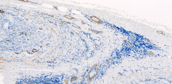 5C3 Perineuritis (Case 5) SMA 10X