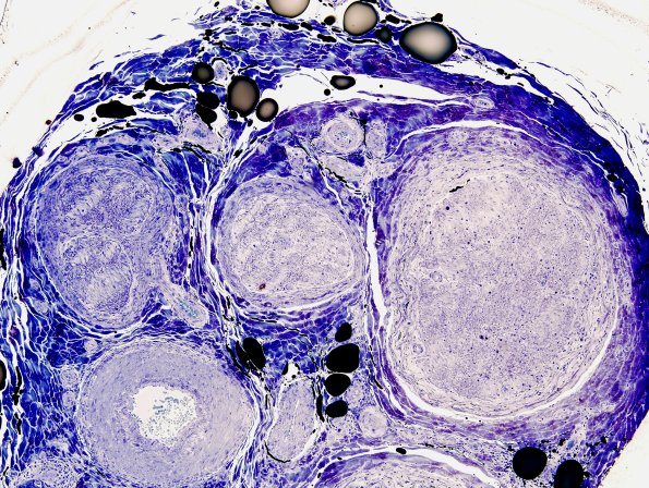 5D1 Perineuritis (Case 5) Plastic 6
