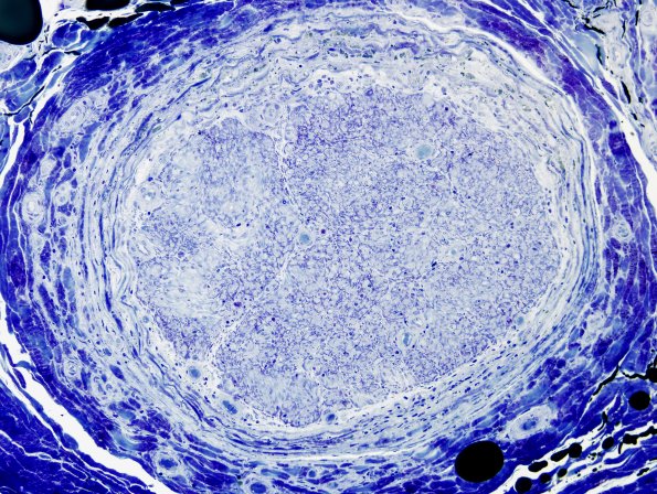 5D3 Perineuritis (Case 5) Plastic 2