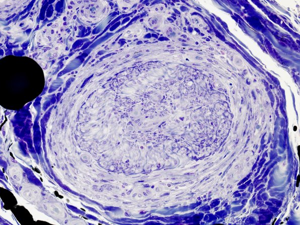 5D4 Perineuritis (Case 5) Plastic 1