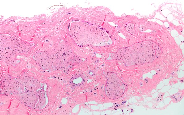 6A1 (Case 6) H&E 10X