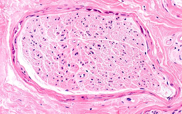 6A2 (Case 6) H&E 40X 1