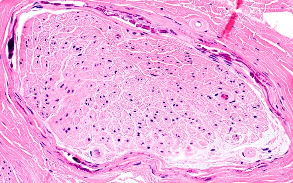 6A3 (Case 6) H&E 40X 3