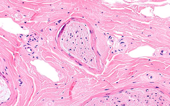 6A4 (Case 6) H&E 40X 2