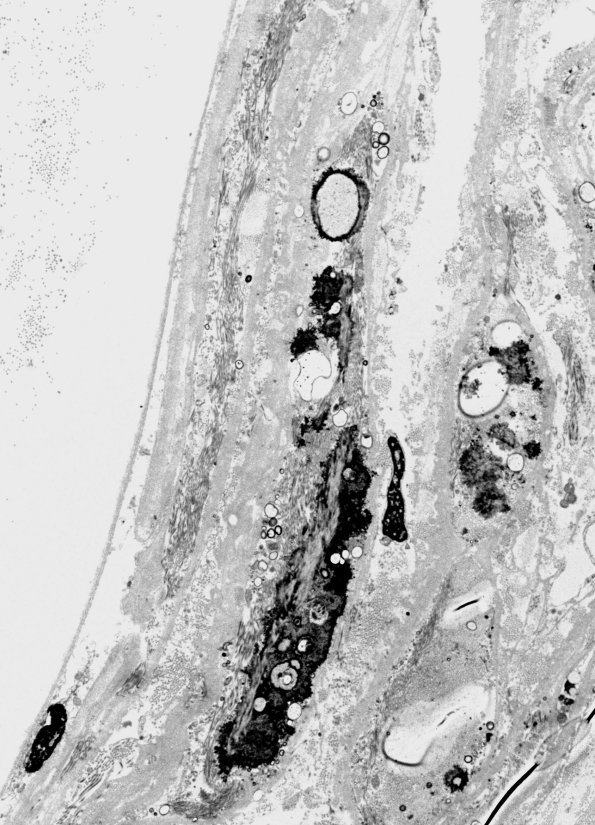 6B1 (Case 6) Nerve_011 - Copy