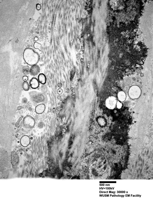 6B3 (Case 6) Nerve_034 - Copy