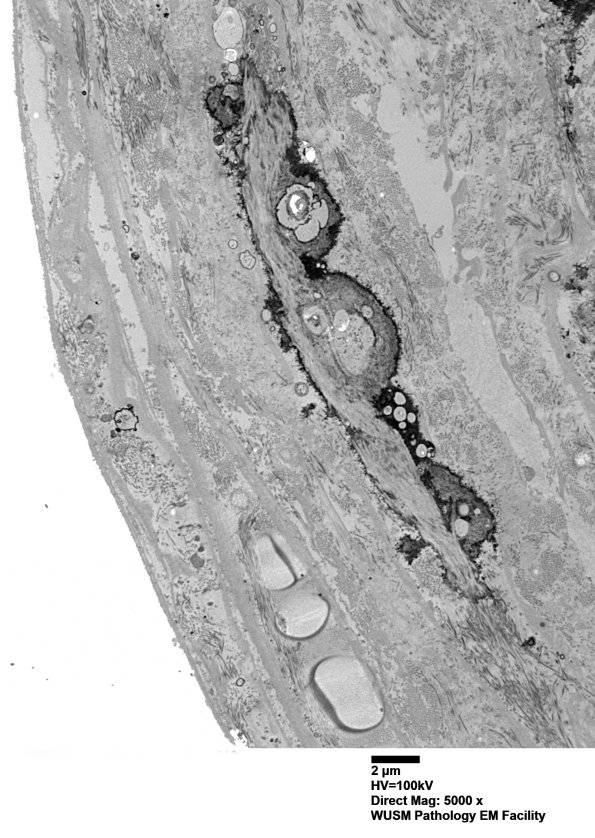 6B4  (Case 6) Nerve 010 - Copy