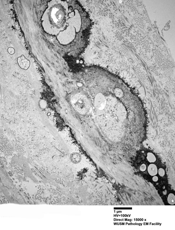 6B5  (Case 6) Nerve 037 - Copy