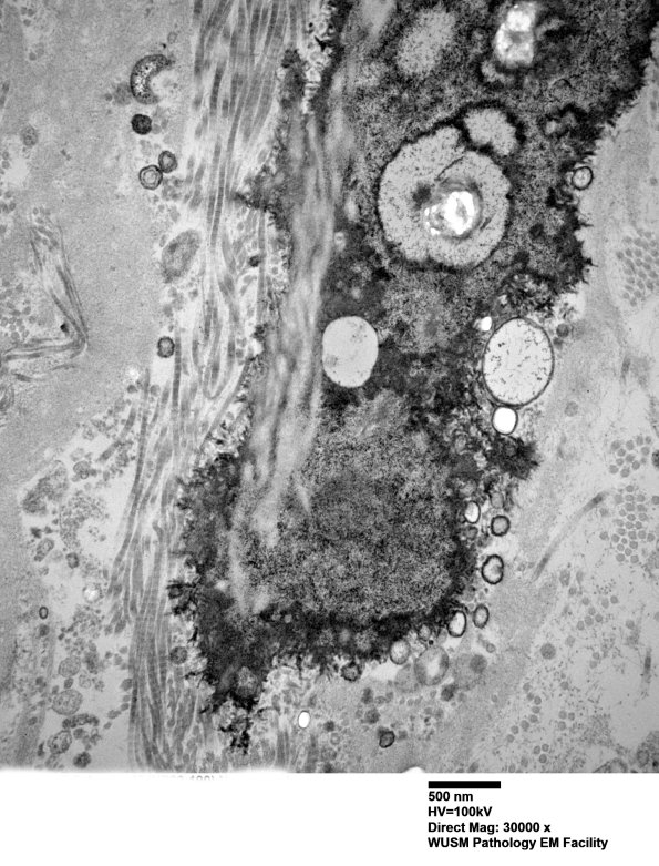 6B6  (Case 6) Nerve 036 - Copy