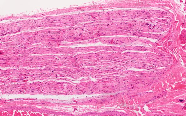 7A1 Hemorrhage, endoneurial (Case 7) Nerve 10X