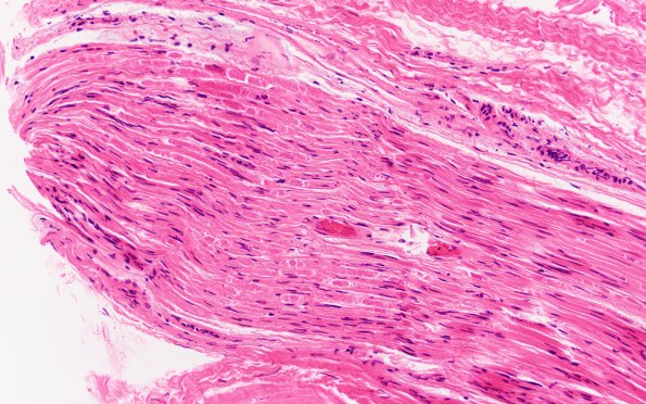 7A2 Hemorrhage, endoneurial (Case 7) Nerve 20X