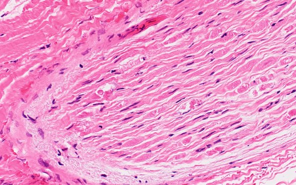 7A3 Hemorrhage, endoneurial (Case 7) Nerve 40X