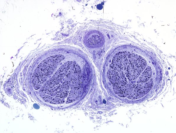 7B1 Hemorrhage, endoneurial (Case 7) Nerve Plastic 1.jpg