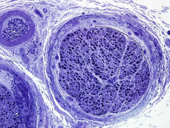 7B2 Hemorrhage, endoneurial (Case 7) Plastic 4.jpg