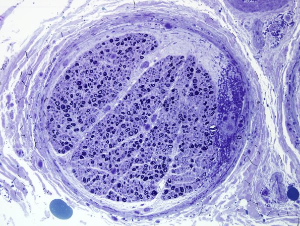 7B3 Hemorrhage, endoneurial (Case 7) Plastic 2.jpg