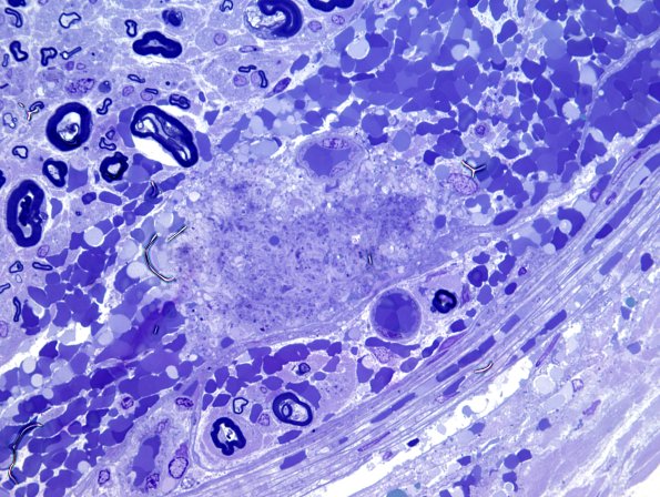 7B5 Hemorrhage, endoneurial (Case 7) Plastic 6.jpg