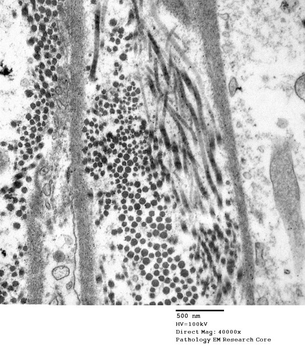 7C1 Axonal Degeneration (Case 7) EM 043 - Copy