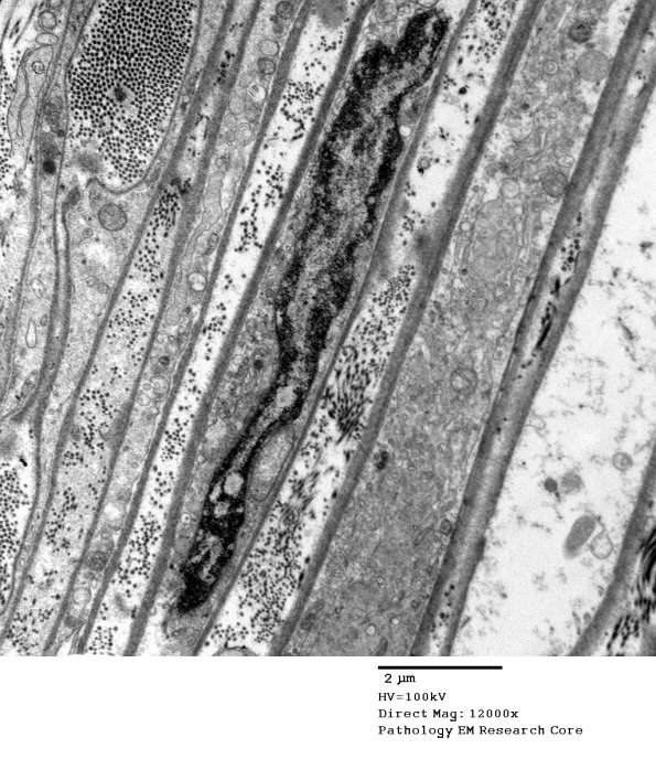 7C2A Axonal Degeneration (Case 7) EM 036 - Copy