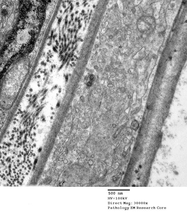 7C2B Axonal Degeneration (Case 7) _037 - Copy