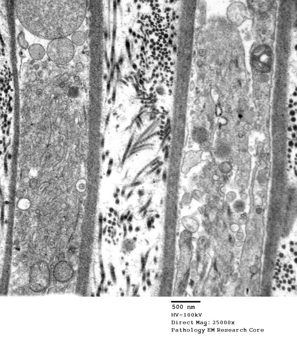 7C2C Axonal Degeneration (Case 7) _040 - Copy
