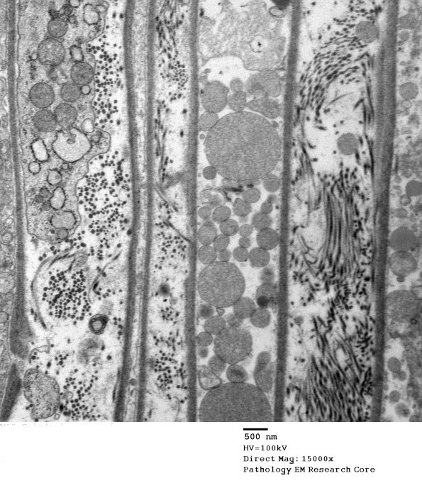 7C3A Axonal Degeneration (Case 7) _039 - Copy
