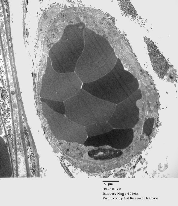 7C4A Axonal Degeneration (Case 7) r_044 - Copy