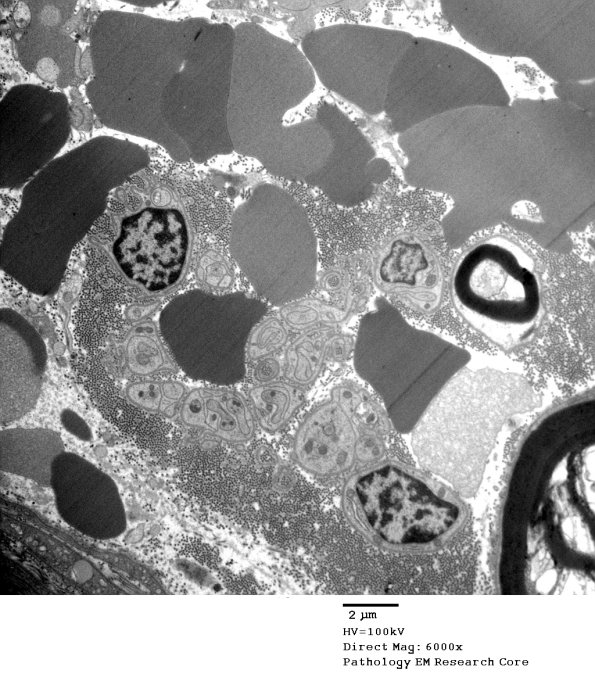 7C4B Axonal Degeneration (Case 7) EM 005 - Copy