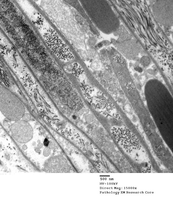 7C5A Axonal Degeneration (Case 7) _038 - Copy
