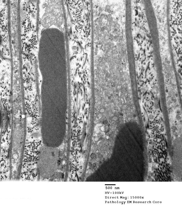 7C5A Axonal Degeneration (Case 7) _041 - Copy