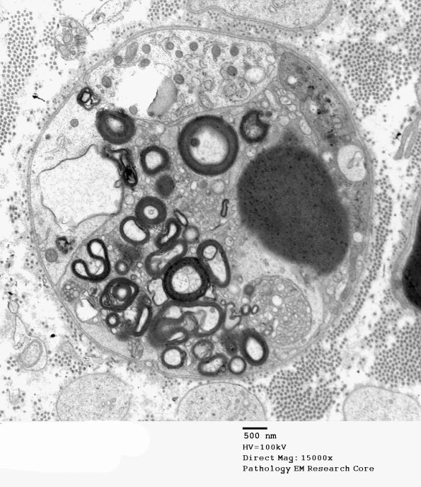 7C6A Axonal Degeneration (Case 7) EM 029 - Copy