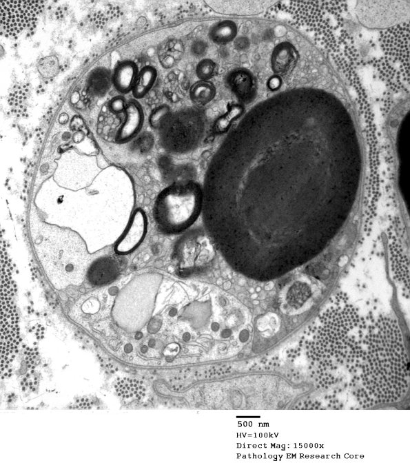 7C6B (Case 7) Nerve Bx_031 - Copy